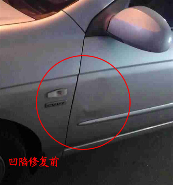 凹陷修复修复前